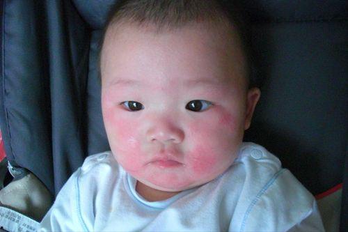 小孩吃角瓜过敏吗,过敏风险知多少？